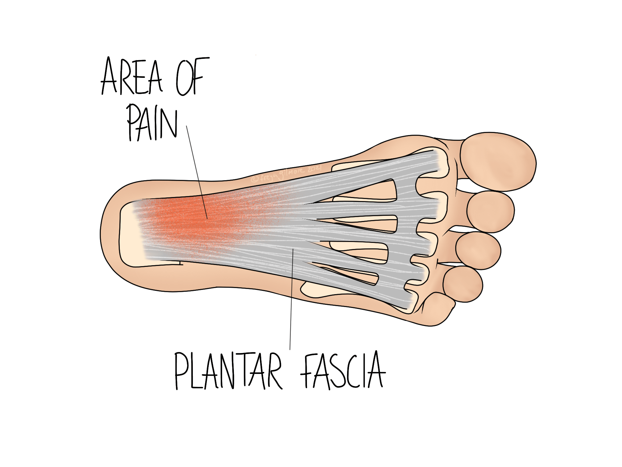 What is Plantar Fasciitis?
