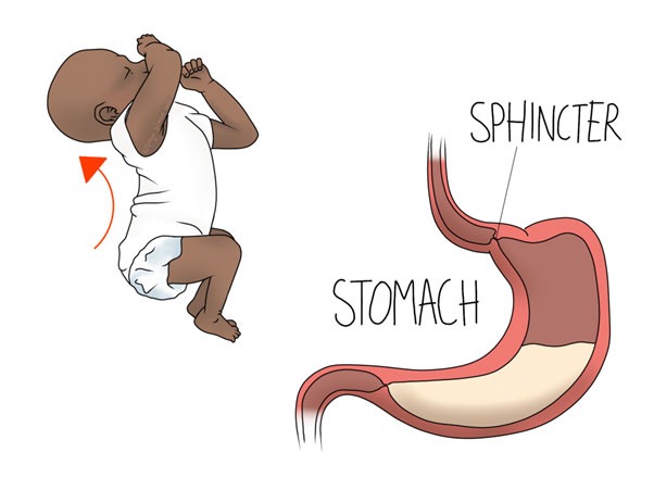 Adult and Infant Reflux img