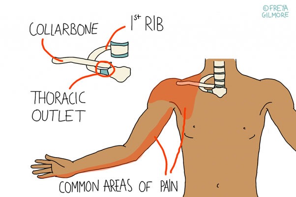 Thoracic Outlet Syndrome img