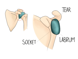 Shoulder Labrum Tears