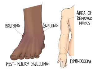 Circulation issues involving swelling