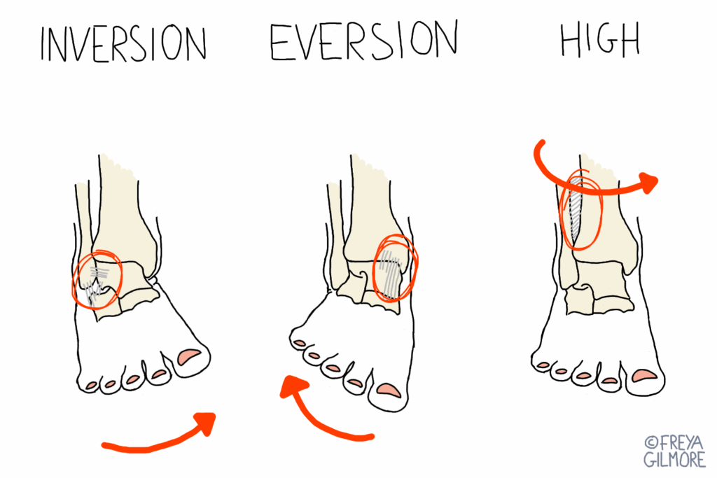 Ankle sprains: common sports injuries